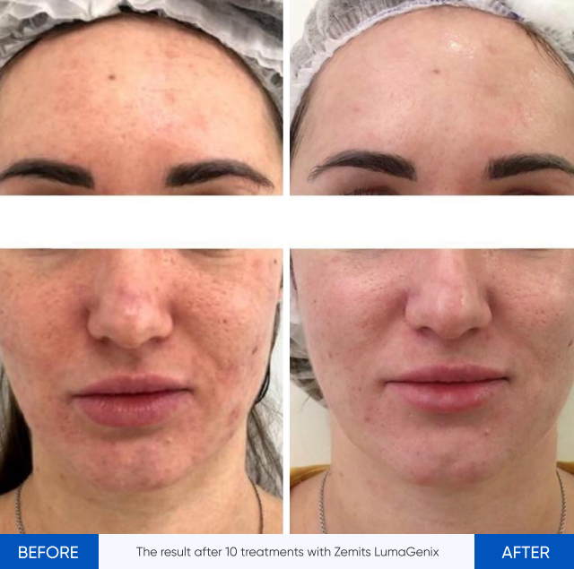 Zemits LumaGenix PDT Profesionální zařízení pro LED světelnou terapii