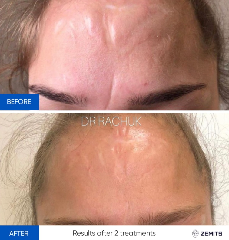 Zemits CarbonFrax Pro: CO2 frakční laser