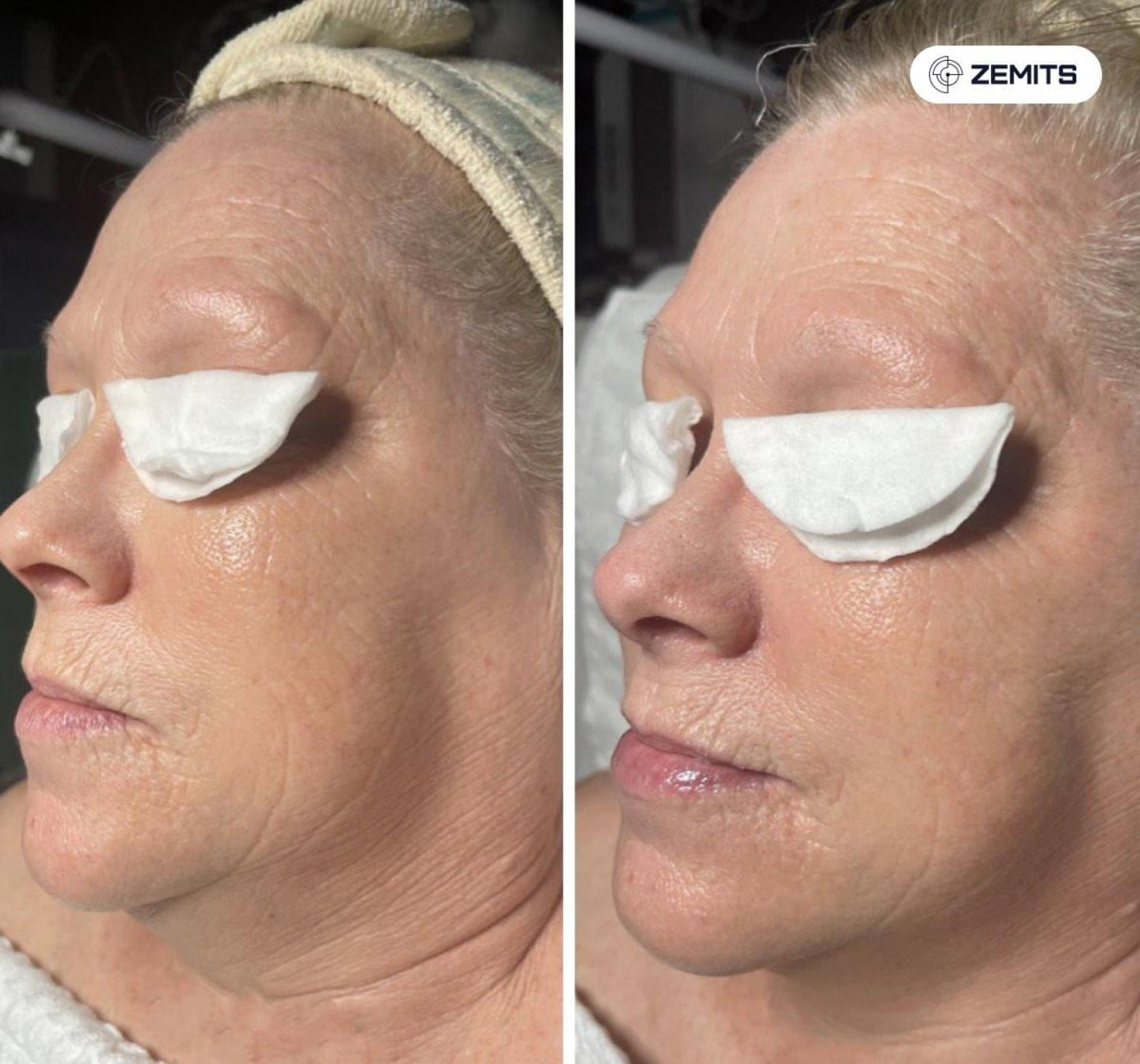 Zemits Klein EL Elektroporační systém