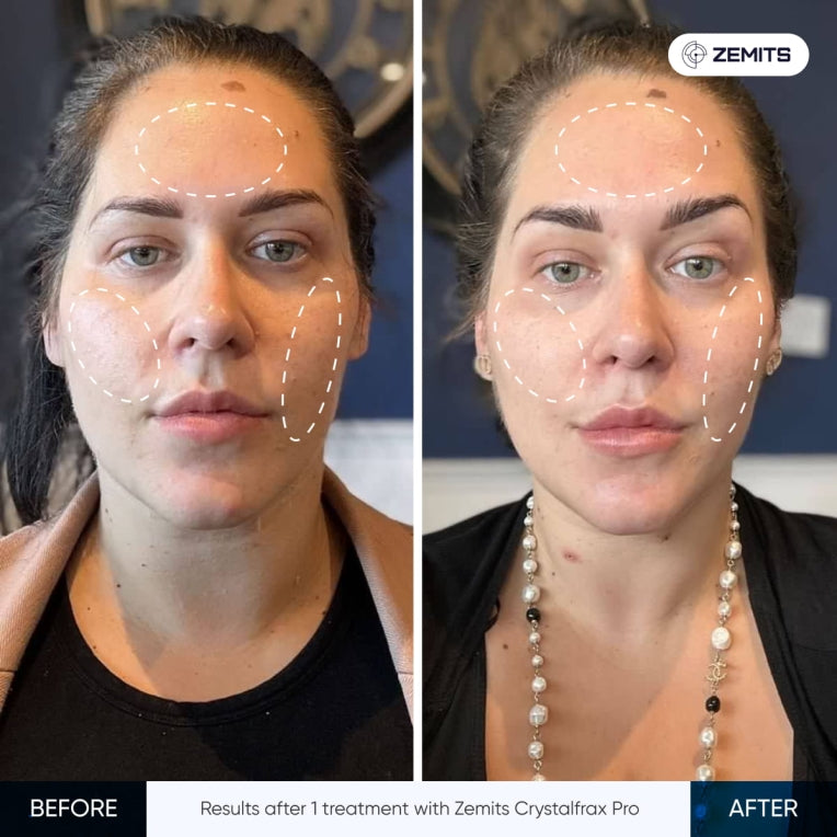 Zemits CrystalFrax PRO Neinvazivní frakční RF systém