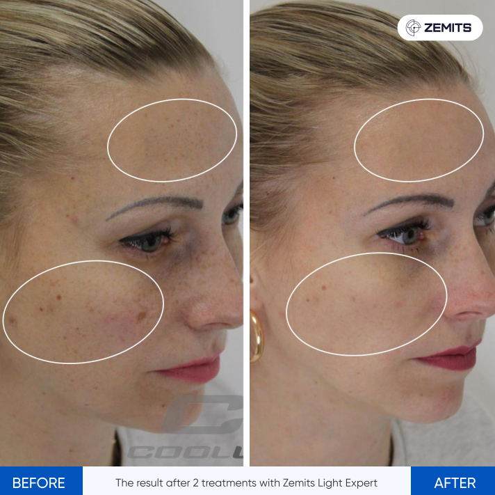 Zemits Light Expert 2.0 IPL laserový přístroj