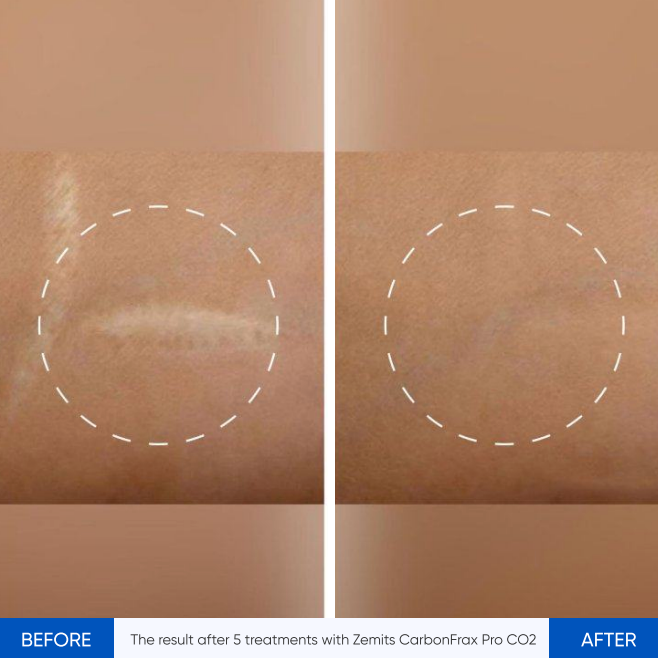 Zemits CarbonFrax Pro: CO2 frakční laser