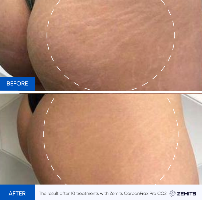 Zemits CarbonFrax Pro: CO2 frakční laser