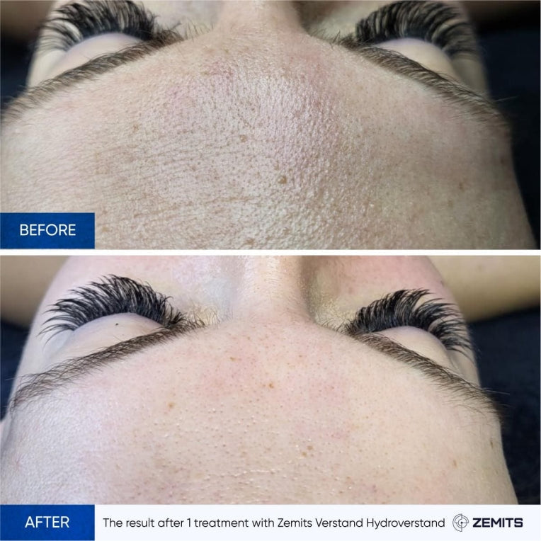 Zemits HydroVerstand PRO 7-v-1 HydroDiamond™ Systém