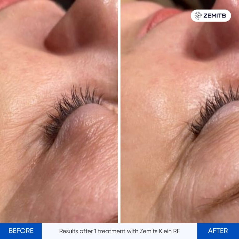 Zemits Klein RF Systém pro zpevnění pokožky
