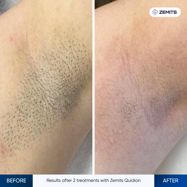 Zemits Quidion diodový laser pro odstranění chloupků