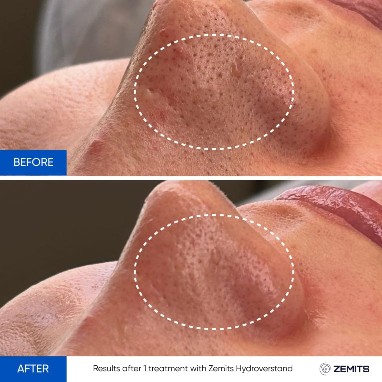 Zemits HydroVerstand PRO 7-v-1 HydroDiamond™ Systém